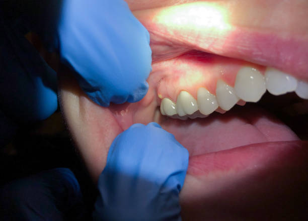 Best Knocked-Out Tooth Emergency  in Wallenuck Lake Estates, PA